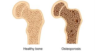 Exercise for Bone Health Part 1: What You Need to Know